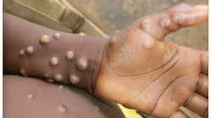 monkeypox