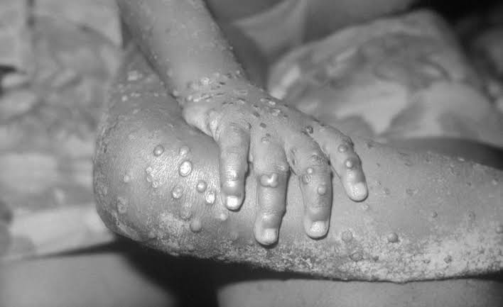 monkeypox