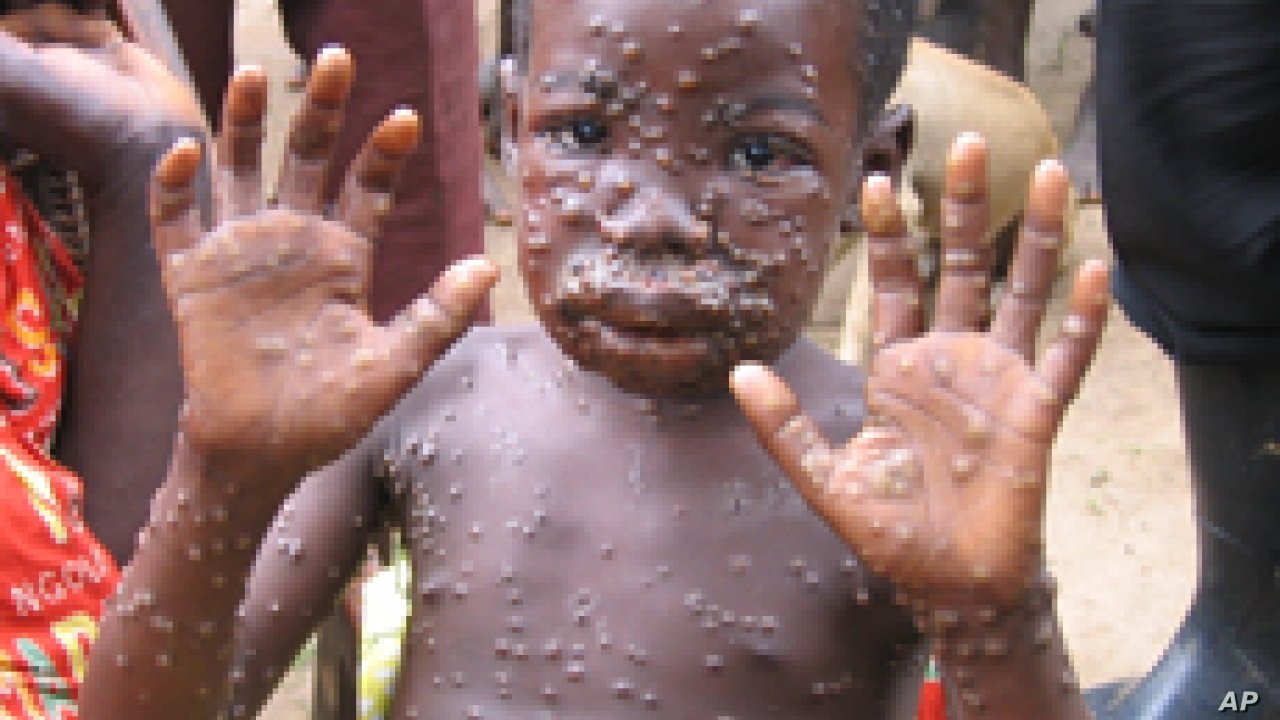 monkeypox